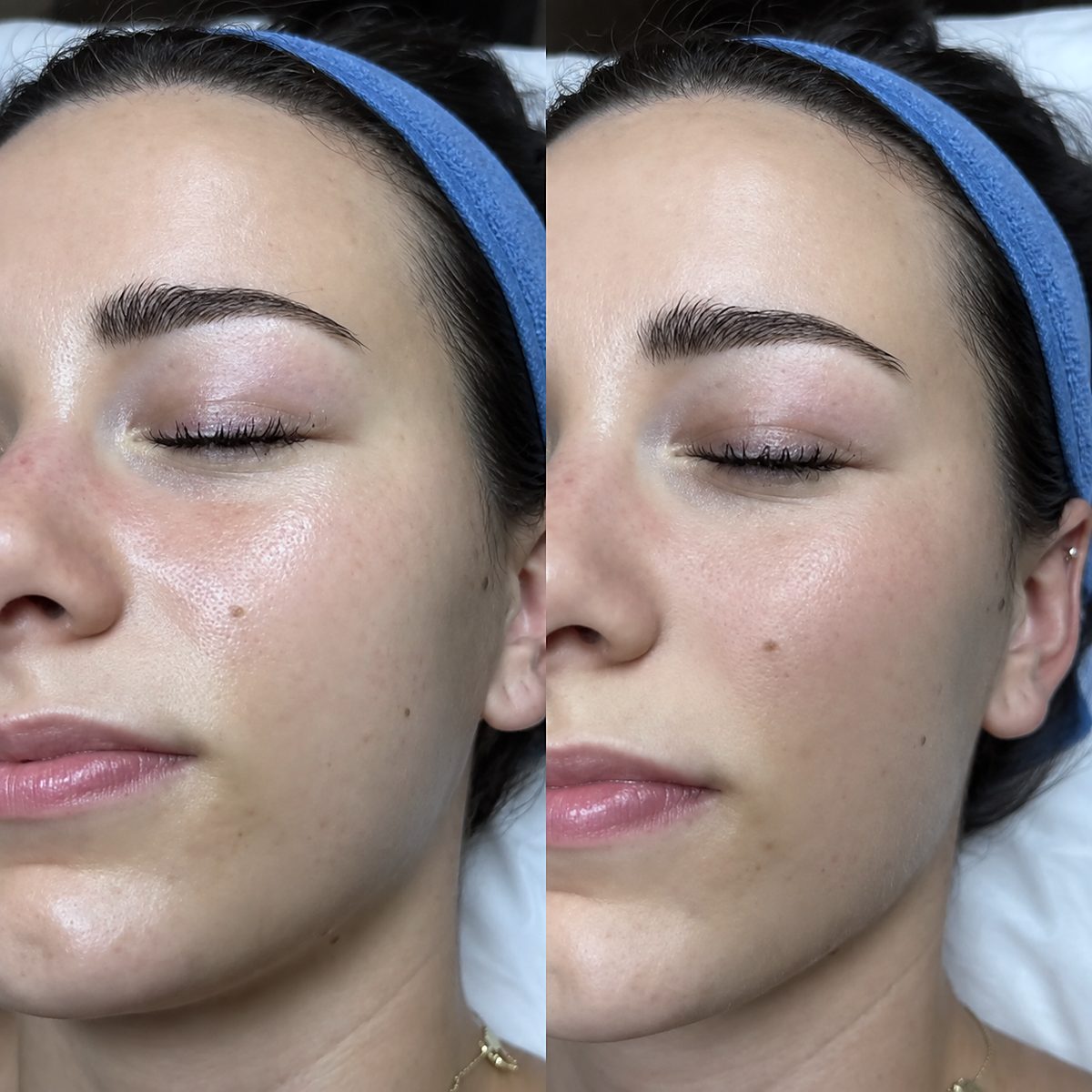 Curso online de dermaplaning